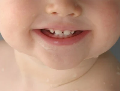 दूध के दांत निकलने के लक्षण और घरेलू उपचार