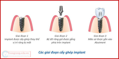 Cấy ghép Implant đẹp an toàn, giá bao nhiêu?