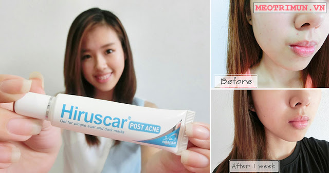 Hiruscar post acne gel review