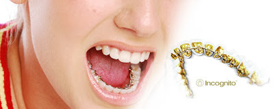 ortodoncia lingual incognito