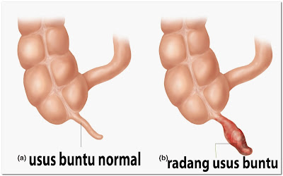 ciri-gejala-penyakit-usus-buntu