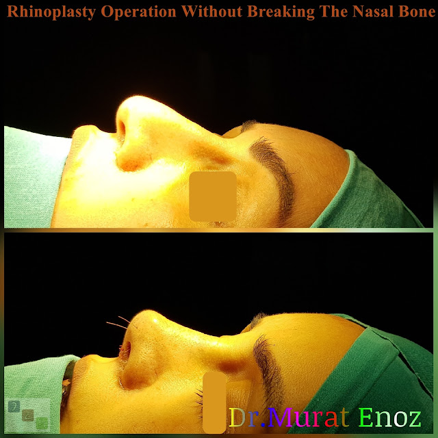 Nose job without bone broken,Rhinoplasty Without Breaking The Nasal Bone in Istanbul,