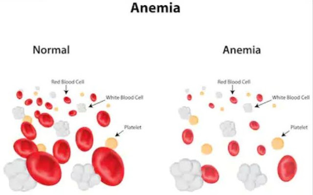 Cure Anemia and Iron Deficiency