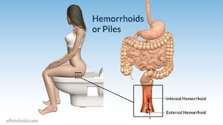 cara mengobati wasir yang sudah kronis, gejala ambeien parah, obat wasir yang aman buat ibu hamil, cara mengatasi wasir dan wasir atau ambeien, pengobatan wasir pdf, cara alami mengatasi penyakit ambeyen, ciri-ciri penyakit wasir atau ambeien dan cara mengobatinya, cara alami mengobati wasir atau ambeien berdarah, obat untuk mengobati wasir efektif, obat alami untuk ambeien parah, cara mengatasi wasir yg berdarah, penyakit wasir apakah itu, mengobati penyakit wasir secara cepat, obat ambeyen wasir atau ambeien herbal, tips mengobati ambeien secara alami, obat untuk penyakit ambeien jeruk nipis, cara alami mengobati penyakit wasir eksternal, cara alami mengobati ambeien atau wasir/wasir, cara mengobati ambeyen yang sudah keluar, cara mengobati penyakit ambeien dengan tomat, obat penyakit ambeien yang gatal, obat alami ambeyen dan ambeien atau wasir, obat untuk penyakit ambeien ala hembing, cara penyembuhan penyakit wasir atau ambeien secara alami, obat ambeien atau wasir untuk ibu hamil yang aman, obat oles wasir wasir, obat herbal ambeien atau wasir kronis, cara mengempeskan benjolan ambeien luar, cara mengobati penyakit ambeien atau wasir/wasir, obat ampuh menghilangkan benjolan ambeien atau wasir