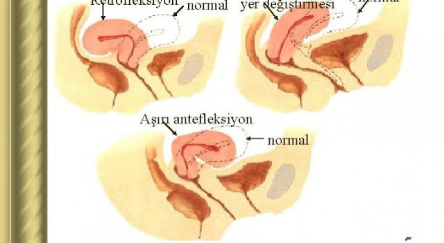 antefleksiyon