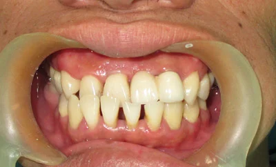 Cạo vôi răng có đau không?