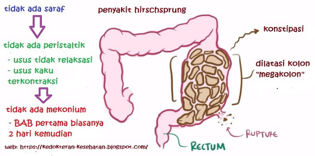 Gambar Penyakit Hirschsprung Disease