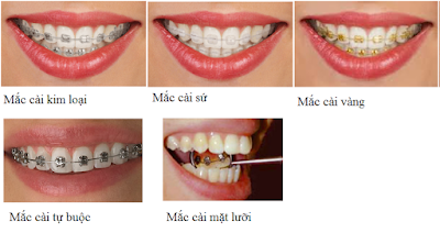 Niềng răng nhanh có an toàn ?