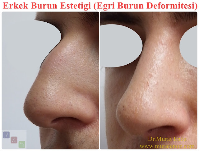 Crooked nose - Deviated nose - Twisted nose - Deflected nose - Asymmetric nose - Scoliotic nose - Eğri burun - C burun - S-shaped crooked nose deformity -  Rhinoplasty Istanbul - Rhinoplasty in Istanbul - Rhinoplasty Turkey - Rhinoplasty in Turkey – Rhinoplasty doctor in Istanbul – ENT doctor in Istanbul - Nose Job in Istanbul - Before and after rhinoplasty photos