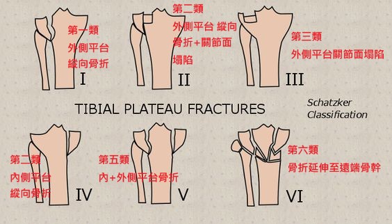 骨科李宜軒醫師 脛骨平台骨折tibia Plateau Fracture 脛骨近端骨折proximal Tibia Fracture