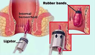 Chữa bệnh trĩ tại Hà Nội: Thủ thuật thắt trĩ bằng vòng cao su