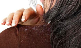 10 powerful natural remedy for dandruff on the scalp