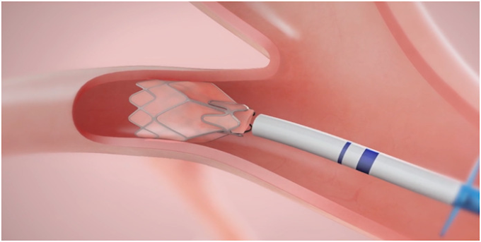 Pulmonx: Minimally Invasive Medical Device for Severe Emphysema