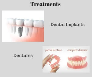 edentulism or tooth loss