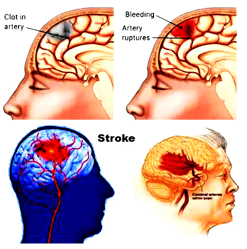 Stroke: Causes, Symptoms, Types, Diagnosis, Prevention and Treatment.