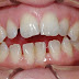 Niềng răng trong suốt là phương pháp gì?