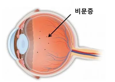 비문증 안구 이미지