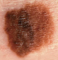 pictures of skin cancer moles