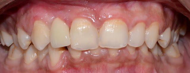 After Cementation of Zirconia Crown over Dental Implant at Jamnagar