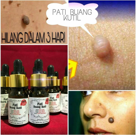 Pati Buang Kutil Ketuat Tahi Lalat Biji Kolestrol Remove 