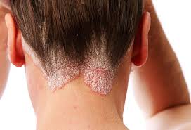 Treating scalp psoriasis on our body with perfect tips Naturally With ayurvedic Remedies