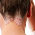 Treating scalp psoriasis on our body with perfect tips Naturally With ayurvedic Remedies