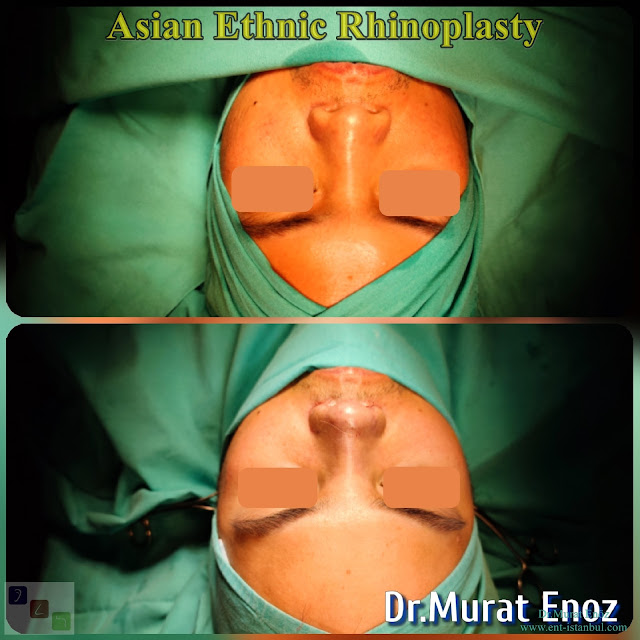 Asian Ethnic Nose Job in Istanbul - Asian Rhinoplasty