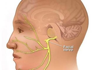 Fisioterapia e a Paralisia Facial