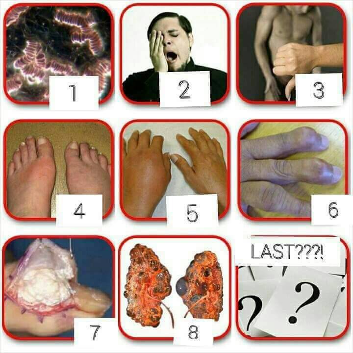 Cara Mengatasi Penyakit Gout serta Pencegahan yang Selamat 