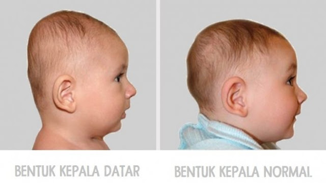 COBA LIHAT KEPALA BAYI ANDA, JIKA BENTUKNYA DATAR, INILAH YANG AKAN TERJADI SAAT DIA BERTUMBUH BESAR 