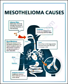 Mesothelioma Cancer Causes