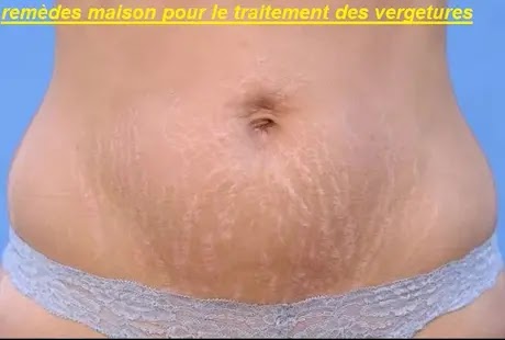 soin anti vergeture grossesse