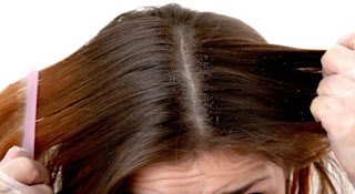 14 Natural ways how do you get rid of dandruff