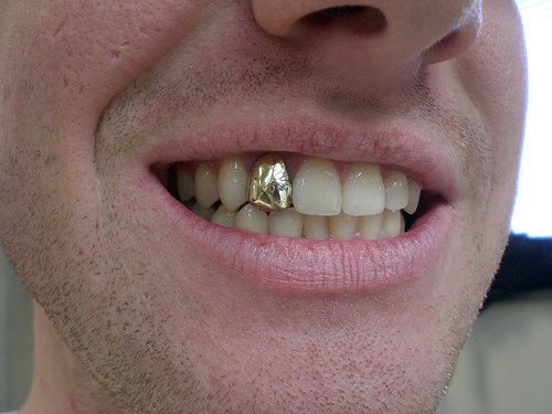 Gold teeth come in two forms : Gold removable dental crowns and gold ...