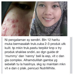 Testimoni Sustained Release Vita-C Plus Shaklee, Bahaya suntikan Vitamin C, Injection Vitamin C, Vitamin untuk Kulit Cantik, Set Kecantikan Shaklee, Petua Kulit Cantik, Rahsia Kulit Cantik, Sustained Release Vita-C Plus Shaklee, 