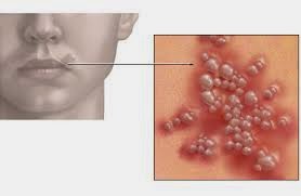 Ciri-Ciri Penyakit Herpes