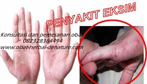 cara mengobati gatal,obat gatal atau eksim,obat eksim,cara menghilangkan gatal pada tangan,cara menghilangkan gatalk pada kaki