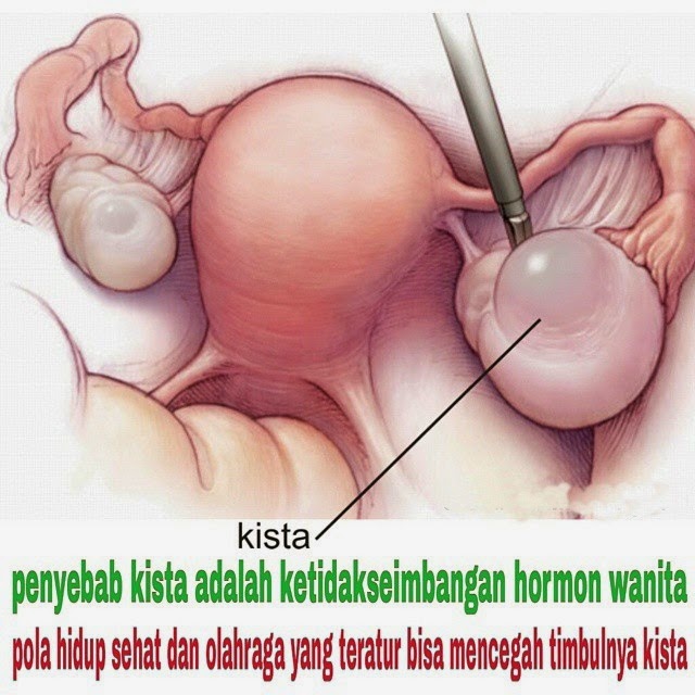 Mengenal Penyakit Kista Ovarium dan Gejala Kista Ovarium