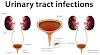 Symptoms, Diagnosis And Treatment Of Cystopyelitis & Urinary Tract Infection