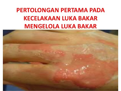 Pertolongan pertama kecelakaan luka bakar