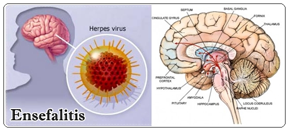 Pengobatan Herbal Ensefalitis Pada Anak