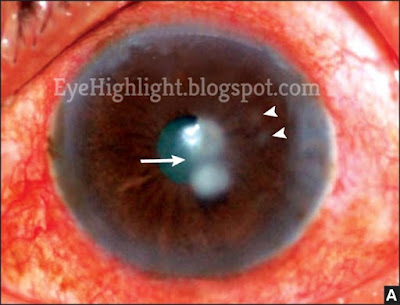 Definition of Treatment Guideline Corneal Ulcer And Healing Times With Picture 2019