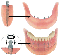 implante dentário e ortodontia