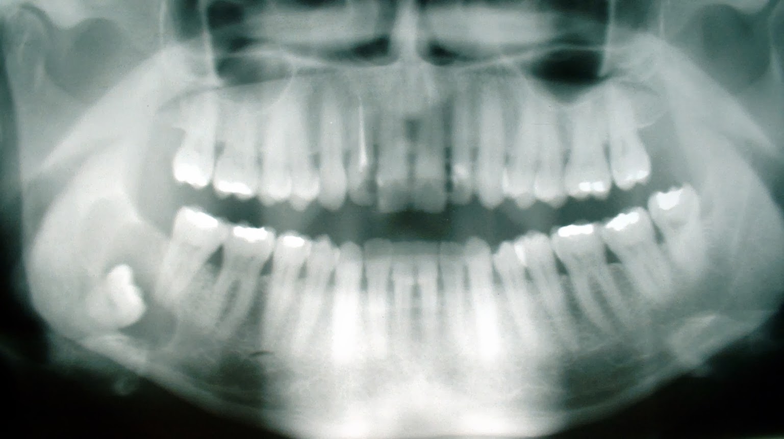 LaserDennisT: Wisdom Behind the Wisdom Teeth