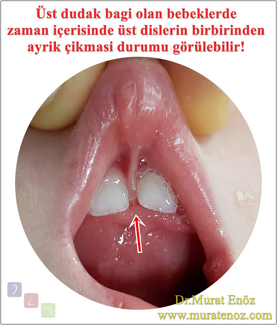 Üst dudak bağı bebeklerde emmeyi nasıl zorlaştırır? - Dudak bağı muayenesi - Dudak bağı belirtileri - Bebeğinizde üst dudak bağını nasıl anlayabilirsiniz? - Bebeklerde üst dudak bağının belirtileri - Üst dudak bağına bağlı dudak ortasında yuvarlak çıkıntı olması - Dudak bağına bağlı üst dişlerde ayrılma