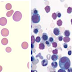 Hereditary Spherocytosis.