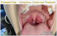 Postnasal Drip  - Symptoms, Causes and Treatment