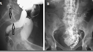 Idiopathic inferior vena caval obstruction