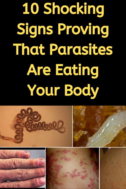 10 Shocking Signs Proving That Parasites Are Eating Your Body 10 Shocking Signs Proving That Parasites Are Eating Your Body