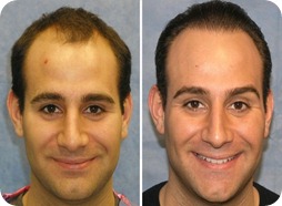 hair Transplant 123